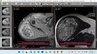 Liposarcoma [upl. by Yoc]