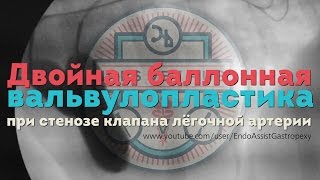 Двойная баллонная вальвулопластика Double Balloon Valvuloplasty in dog [upl. by Motch]