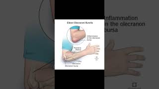 Elbow bursitisexcercisethephysiodoctoranatomyphysiotharapisthumananatomysportselbowpain [upl. by Gerrilee]