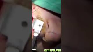 Lt Buccal Haemangioma Excisionhttpsyoutubecomfazaliwahid9397siTsINz7FGtR0c8p [upl. by Hctud]