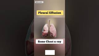 Pleural Effusion amp Chest Xrays [upl. by Einaffit]