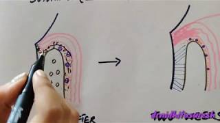 Periodontal flap Part 2 carranza chap57 [upl. by Ameline]