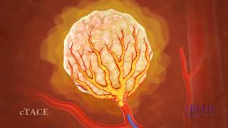 Liver Tumor Embolization amp Chemoembolization [upl. by Eigla]