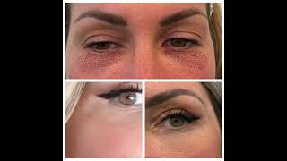 Blepharoplastie supérieure et laser paupières inférieures pour un rajeunissement rapide et durable [upl. by Hoashis]