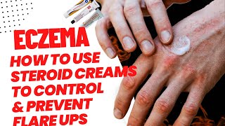 How To Treat Eczema And Prevent Flare ups SAFELY With Steroid Creams  Eczema Tips [upl. by Llet]