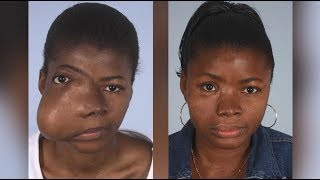 Maxillofacial Surgery Changing Faces Changing Lives  Kadiatus Story [upl. by Lleon]