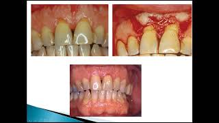 Periodontal flap Dr Enas Elgendy [upl. by Neirad832]