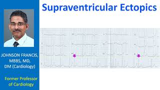 Supraventricular Ectopics [upl. by Eceinehs]