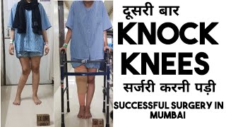 Unsuccessful surgery of knock knee Dr namisha did again right knock knee surgery in mumbai [upl. by Ainoda]