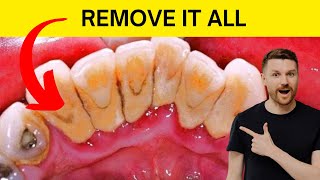 DIY Teeth Cleaning Infallible Remove Tartar at Home Safely [upl. by Thorlie]