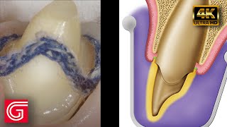 Soft Tissue Management and Impression Technique by Michael DiTolla DDS FAGD [upl. by Annoek]