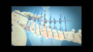 Scoliosis Surgical Correction with Instrumentation [upl. by Florida56]