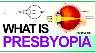 What is Presbyopia Class 10  Causes  Correction for Presbyopia  Defects of Vision Grade10 Physics [upl. by Lohcin574]