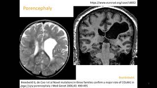 10 Schizencephaly porencephaly COL4A1 mutation congenital CMV open lip closed lip birth defect [upl. by Rosabel]