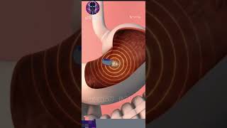 Stomach endoscopy procedure3D animationHD medical video [upl. by Hetty631]