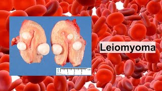 leiomyoma [upl. by Anoy]