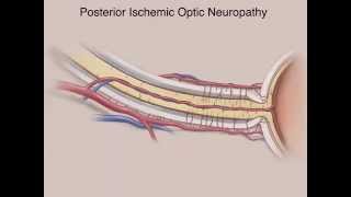 Ischemic Optic Neuropathies [upl. by Anaeed]