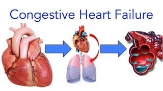 Congestive Heart Failure CHF Explained  MADE EASY [upl. by Matejka]