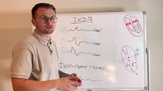 EKG Series How to quickly spot an IntraVentricular Conduction Delay IVCD and Hyperkalemia [upl. by Asiar]