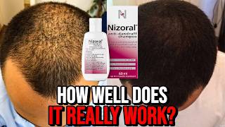 Ketoconazole Shampoo for Hair Growth  How Well Does it REALLY Work [upl. by Adebayo341]