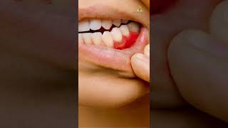 Pyorrhea Part1 dental oralhealth dentist dentalcavity cavity doctor knowledge teeth facts [upl. by Orfield]