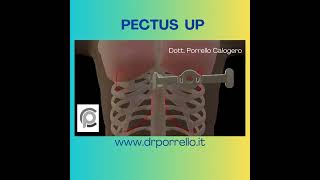 PECTUS UP DOTT PORRELLO [upl. by Chery]